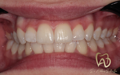 whitening-fluorosis-after3