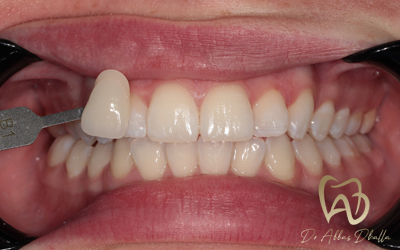 whitening-fluorosis-after5
